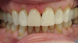 Angela - Composite Veneers, Teeth Whitening after