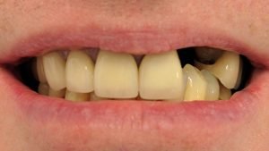 Philip - Dental Implants before