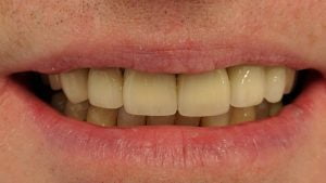 Philip - Dental Implants after