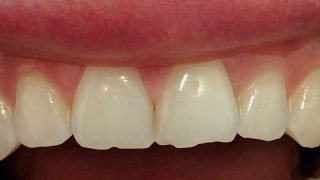 Joanna - Composite Veneers, Tooth-Coloured FIllings, Teeth Whitening before