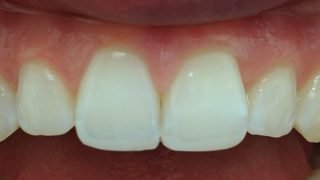 Joanna - Composite Veneers, Tooth-Coloured FIllings, Teeth Whitening after