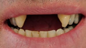 Neil - Dental Implants before