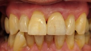 Barry - Porcelain Crowns after
