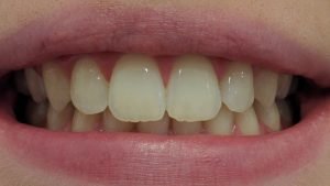 Lilly - Teeth Whitening before