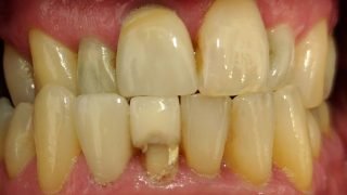 Bill - Porcelain Crowns before