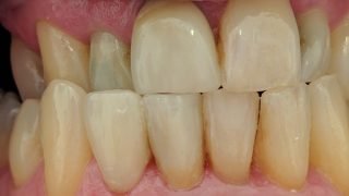 Bill - Porcelain Crowns after