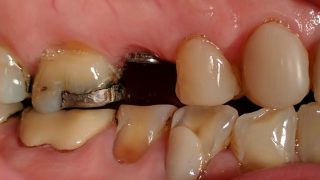 Elsie - Dental Implants, Composite Veneers before