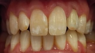 Dan - Porcelain Crowns after