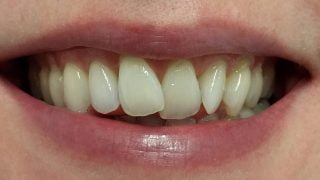 Katie - Composite Veneers, Teeth Whitening before