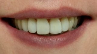 Katie - Composite Veneers, Teeth Whitening after