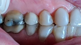 Elsie - Dental Implants, Composite Veneers after