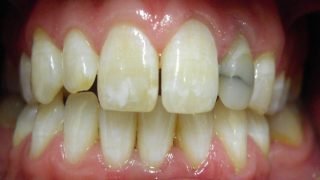 Dan - Porcelain Crowns before