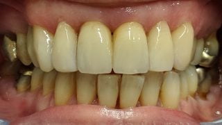 Melanie - Composite Veneers after