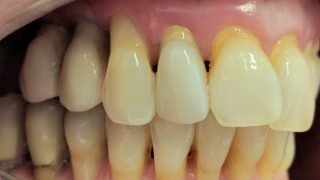 Stacey - Dental Implants, Porcelain Crowns, Teeth Whitening after