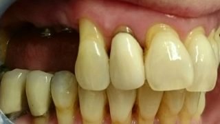 Stacey - Dental Implants, Porcelain Crowns, Teeth Whitening before