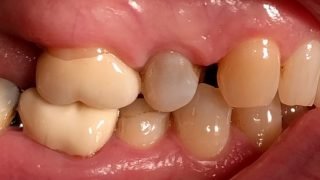 Jennifer - Composite Veneers before