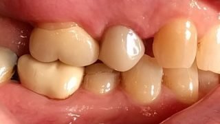 Jennifer - Composite Veneers after