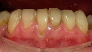 Paul - Composite Veneers after