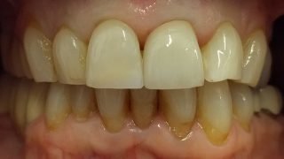 Andrea - Porcelain Crowns, Tooth-Coloured FIllings after