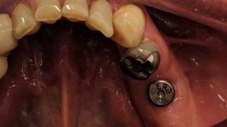 Jim - Dental Implants before