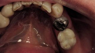 Jim - Dental Implants after
