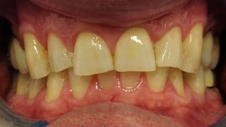 Frank - Composite Veneers before