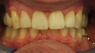 Frank - Composite Veneers after