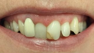 Sophie - Porcelain Crowns, Composite Veneers, Tooth-Coloured Fillings before