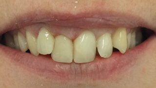 Sophie - Porcelain Crowns, Composite Veneers, Tooth-Coloured Fillings after
