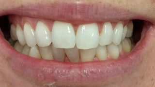 Paula - Teeth Whitening after