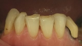 Gerry - Composite Veneers before