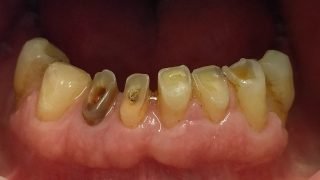 Simon - Composite Veneers before
