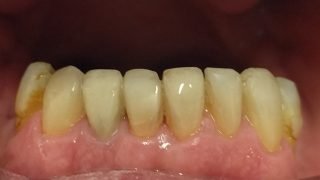 Simon - Composite Veneers after