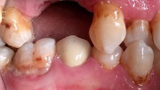 Michael - Dental Implants before