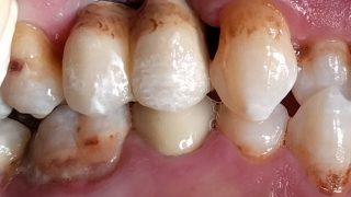 Michael - Dental Implants after
