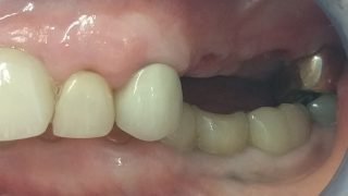 Joan - Dental Implants before