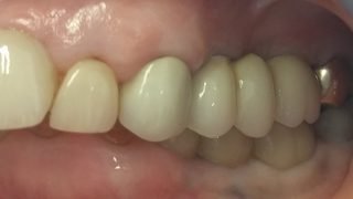 Joan - Dental Implants after
