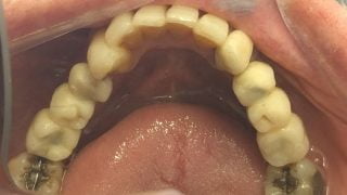 George - Dental Implants after