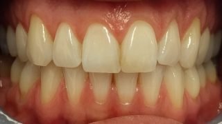 Polly - Teeth Whitening before