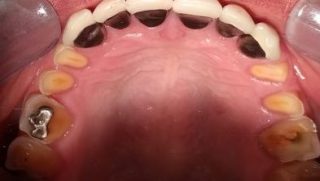 Jenny - Porcelain Crowns, Tooth-Coloured FIllings before