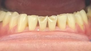 Jenny - Composite Veneers before