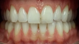 Polly - Teeth Whitening after