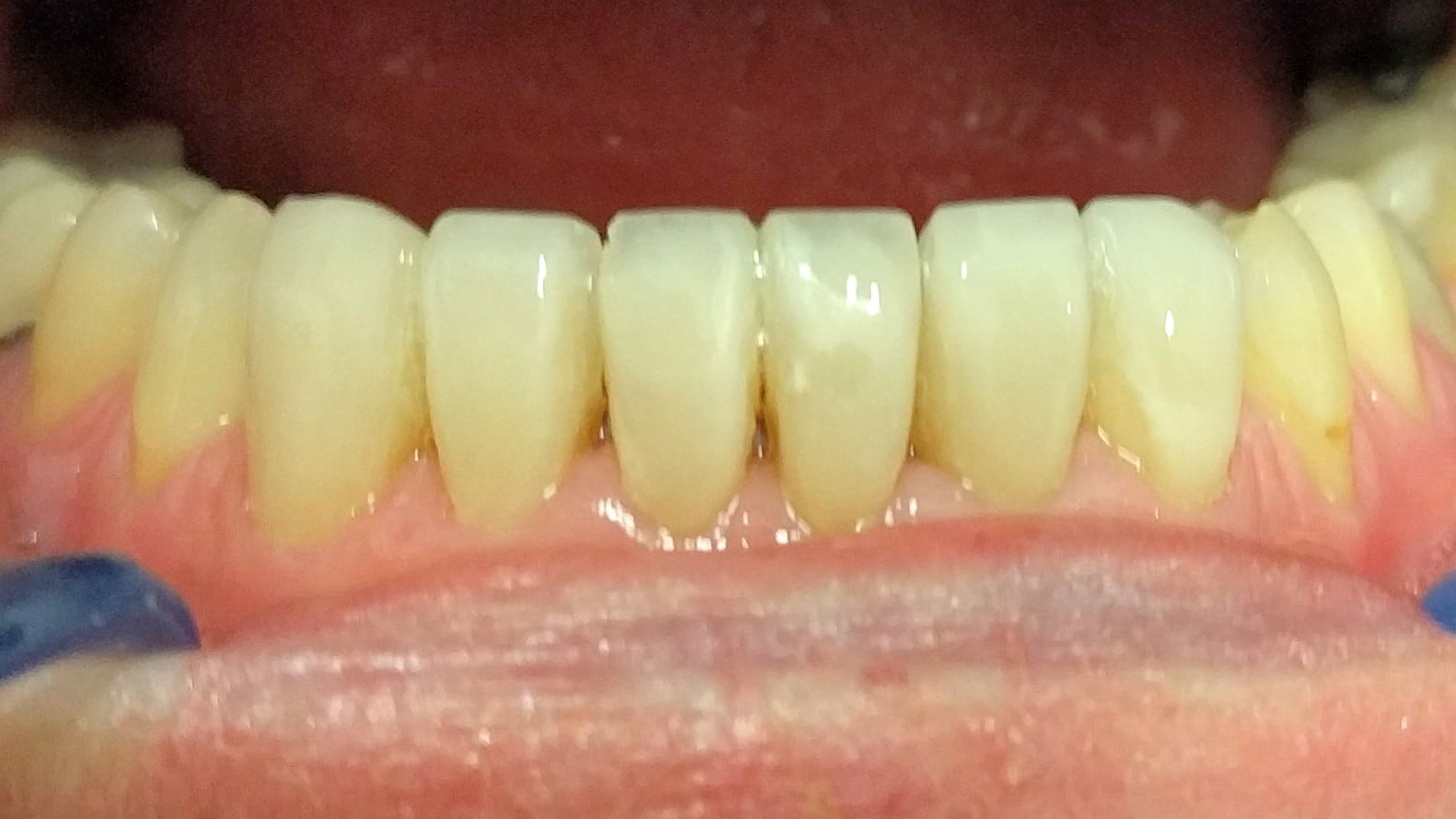 Jenny - Composite Veneers after