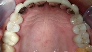 Jenny - Porcelain Crowns, Tooth-Coloured FIllings after