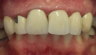 Winnie - Porcelain Crowns before