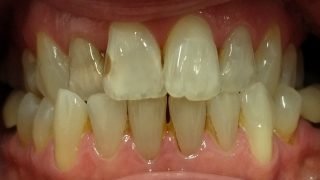 Vicky - Composite Veneers, Teeth Whitening before