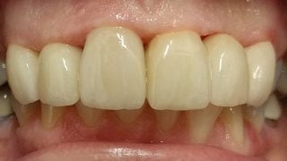 Winnie - Porcelain Crowns after