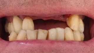 Phil - Dental Implants before