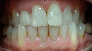 Vicky - Composite Veneers, Teeth Whitening after