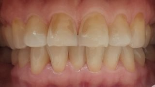 Liz - Composite Veneers before